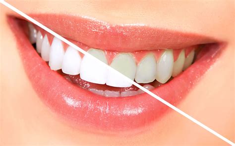 The Best Foods and Drinks to Avoid for Whiter Teeth After Magic White Teeth Whitening